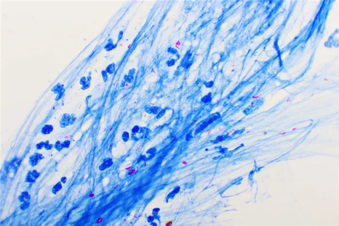 Микобактерия туберкулеза под микроскопом (красная) Jarun Ontakrai / Shutterstock / FOTODOM
