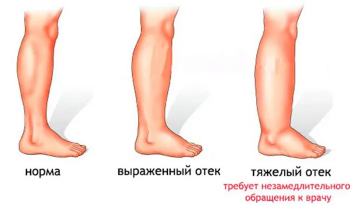Отеки ног - Изображение 1 - Сеть клиник Семейный доктор